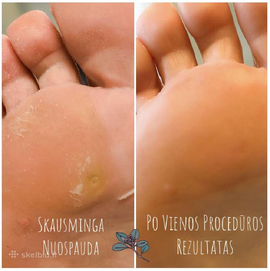 Senjorų Nagų Ir Pėdų Priežiūra Namuose - nuotraukos Nr. 6