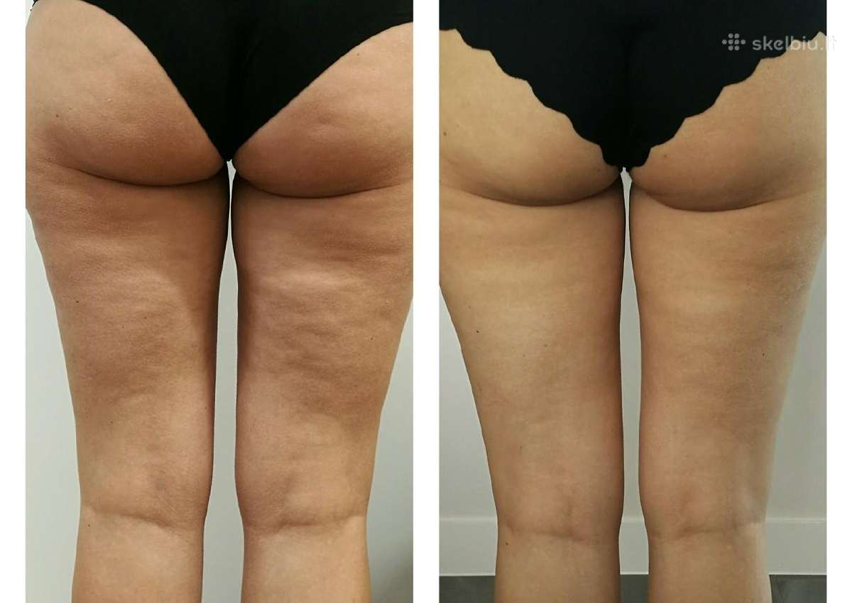 Originalus Velashape II kuno aparatas - nuotraukos Nr. 4
