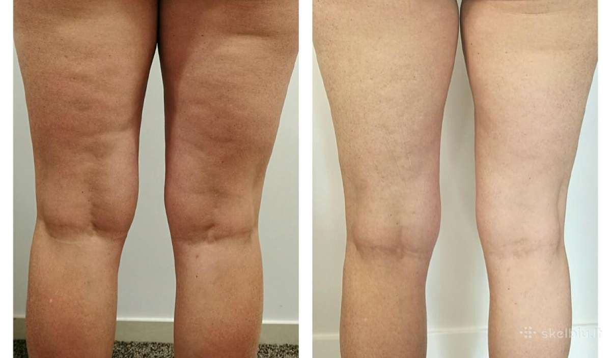 Originalus Velashape II kuno aparatas - nuotraukos Nr. 5