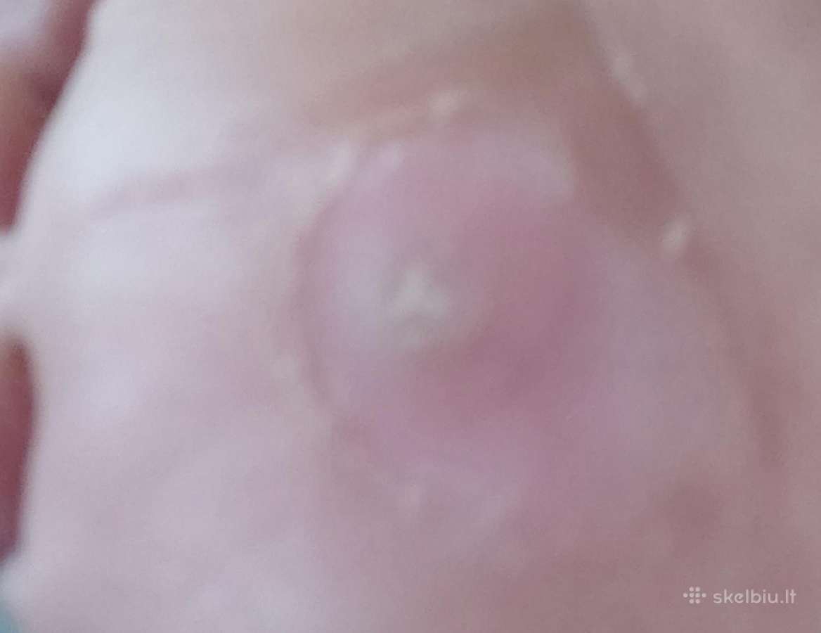 Pleistrai nuospaudoms ir karpoms gydyti 6 vnt-2.5€ - nuotraukos Nr. 2