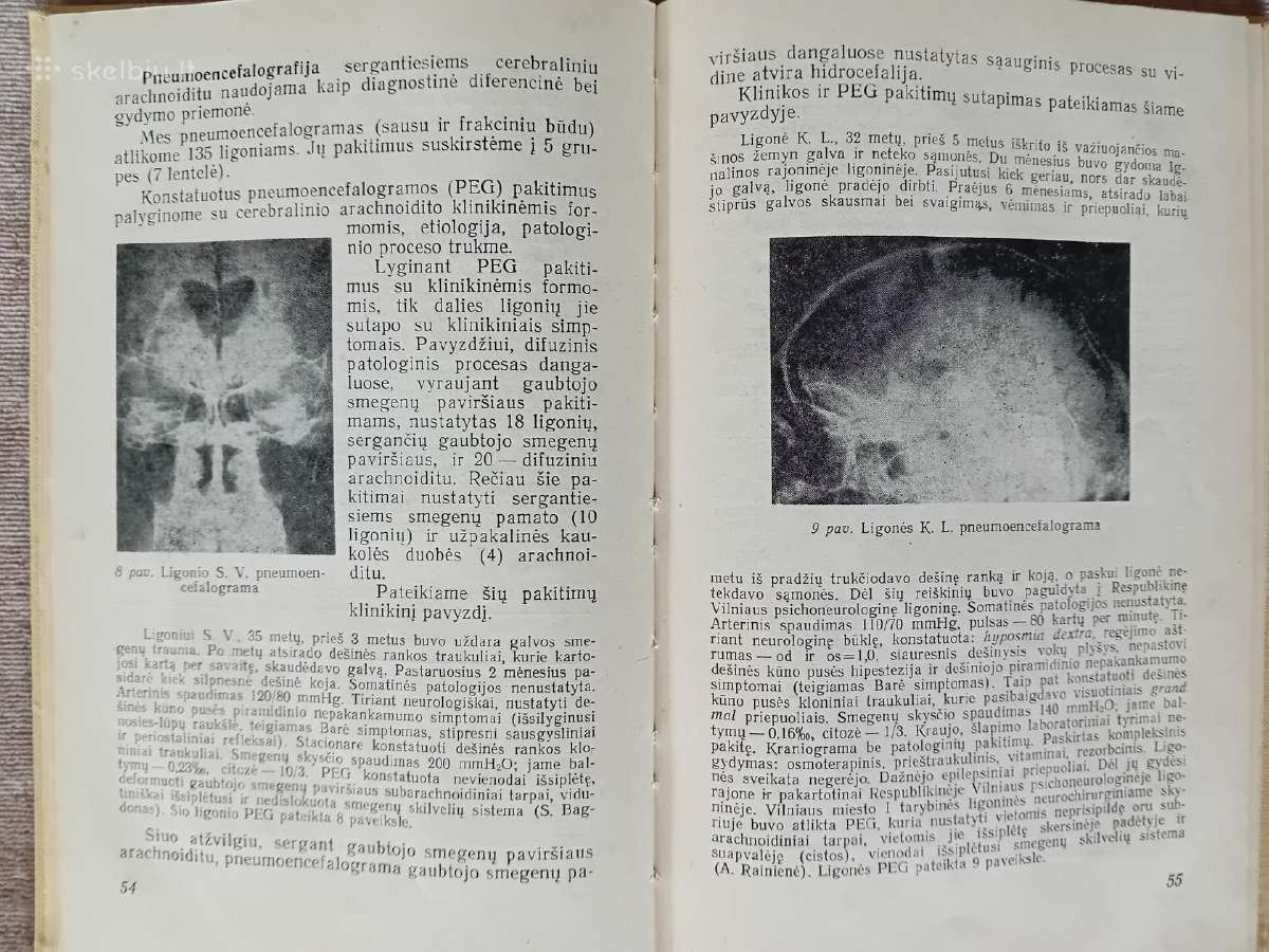 Cerebralinis Arachnoiditas, Urologija - nuotraukos Nr. 3