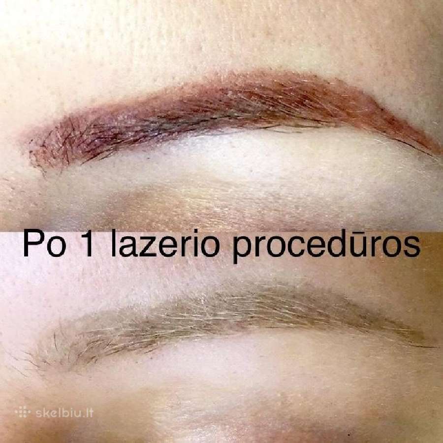 Nekokybiško permanentinio makiažo šalinimas - nuotraukos Nr. 5