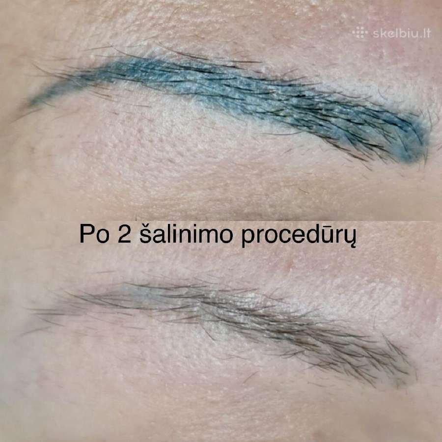 Nekokybiško permanentinio makiažo šalinimas - nuotraukos Nr. 6