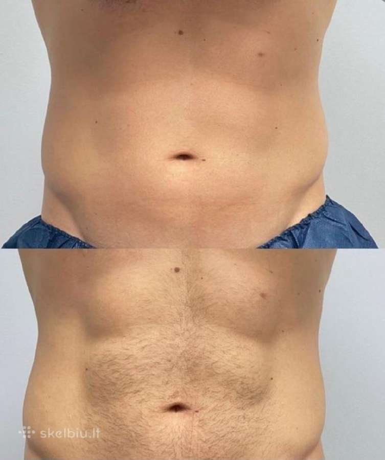 Depiliacija Vyrams .pilnas bikinis tik 40€. - nuotraukos Nr. 3