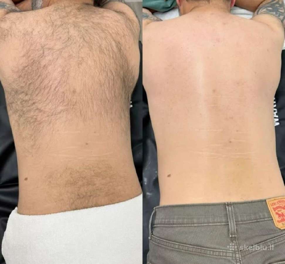 Depiliacija Vyrams .pilnas bikinis tik 40€. - nuotraukos Nr. 4