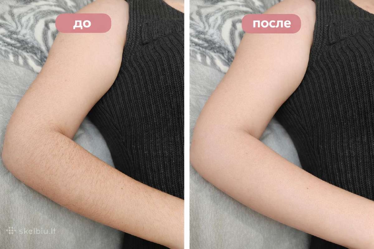 Depiliacija Vilniuje Moterims ir vyrams - nuotraukos Nr. 5