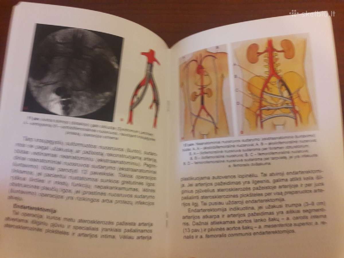 Lėtinės chirurginės pilvinės aortos ir kojų arteri - nuotraukos Nr. 2