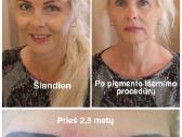 Permanento šalinimas: PRIEŠ ir PO - nuotraukos Nr. 12