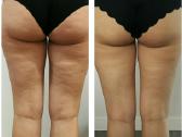 Originalus Velashape II kuno aparatas - nuotraukos Nr. 4