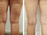 Originalus Velashape II kuno aparatas - nuotraukos Nr. 5
