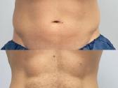 Depiliacija Vyrams .pilnas bikinis tik 40€. - nuotraukos Nr. 3